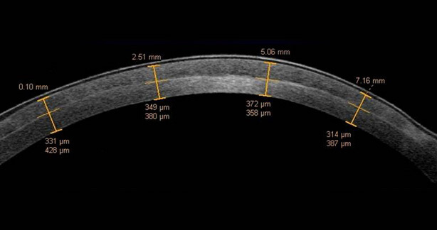 Pachimetria: Essenziale nella Diagnosi e nel Trattamento Oculare